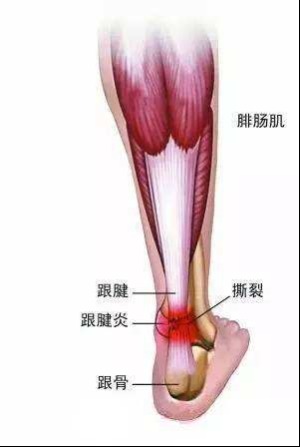 跟腱又称为阿基里斯腱(源于希腊神话中的"阿基里斯之踵"),是位于小腿